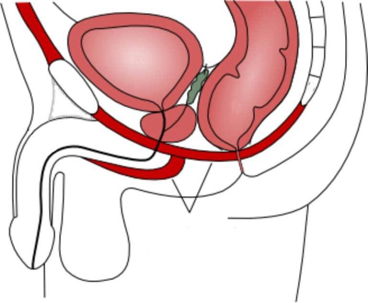 pagbansay sa pelvic floor kaunoran sa pagpalambo sa potency